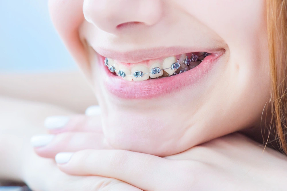 Orthodontic Treatment - Rayyan Dental Clinic in Rayyan